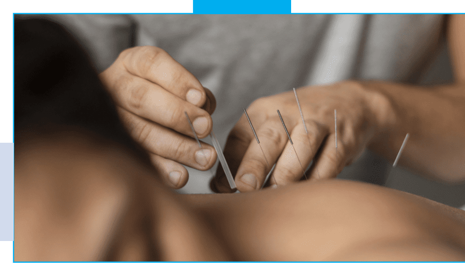 A person is using acupuncture needles on the back of their body.